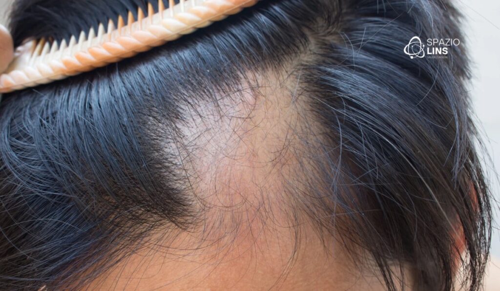 Falta de vitaminas causa queda de cabelo? Veja quais exames investigar