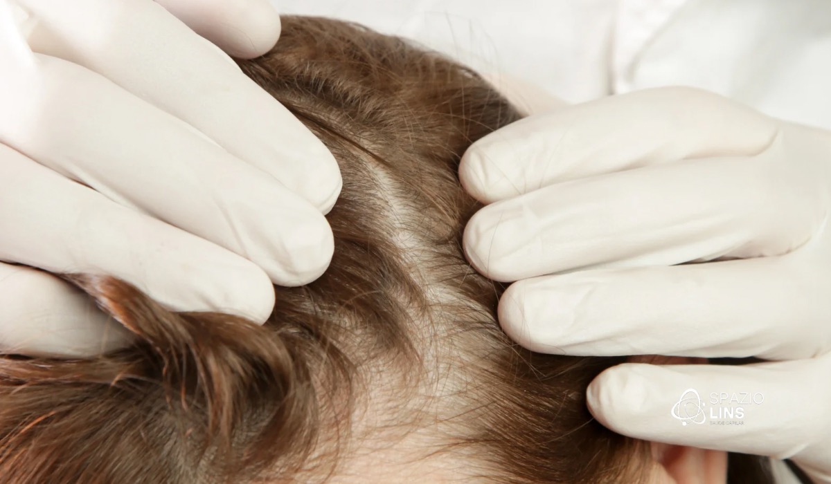 Falta de vitaminas causa queda de cabelo? Veja quais exames investigar