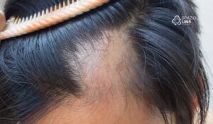 Falta de vitaminas causa queda de cabelo? Veja quais exames investigar