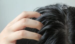 Oleosidade no couro cabeludo causa queda de cabelo? Entenda a verdade