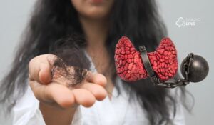 Por que o cabelo cai no hipotireoidismo?