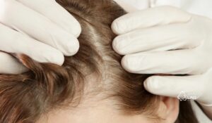 Quem tem lúpus tem queda de cabelo?