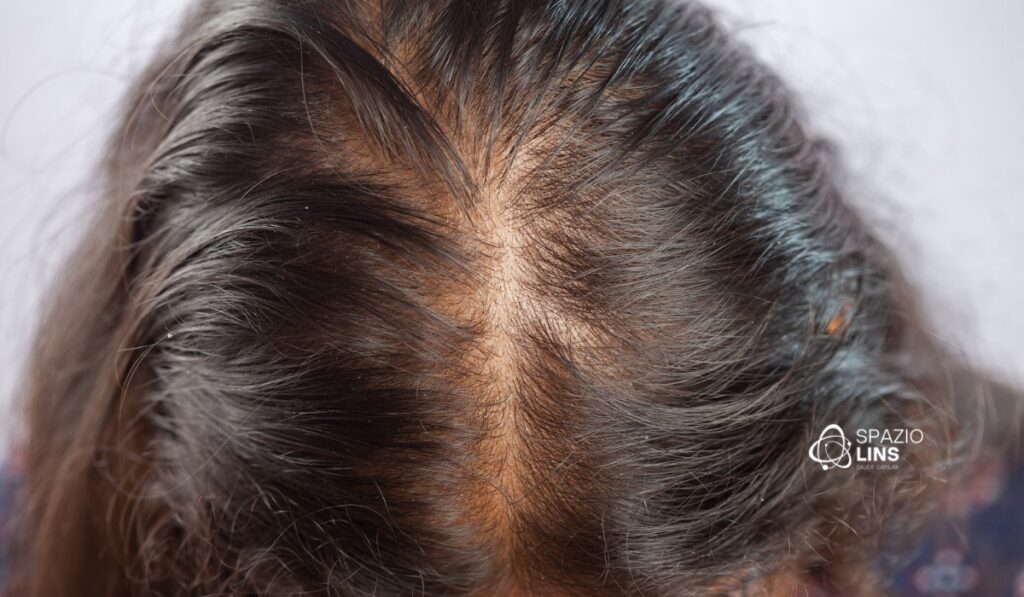 O que é alopecia? Entenda as causas, sintomas e tratamentos