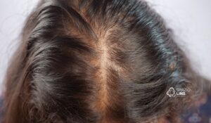 O que é alopecia? Entenda as causas, sintomas e tratamentos