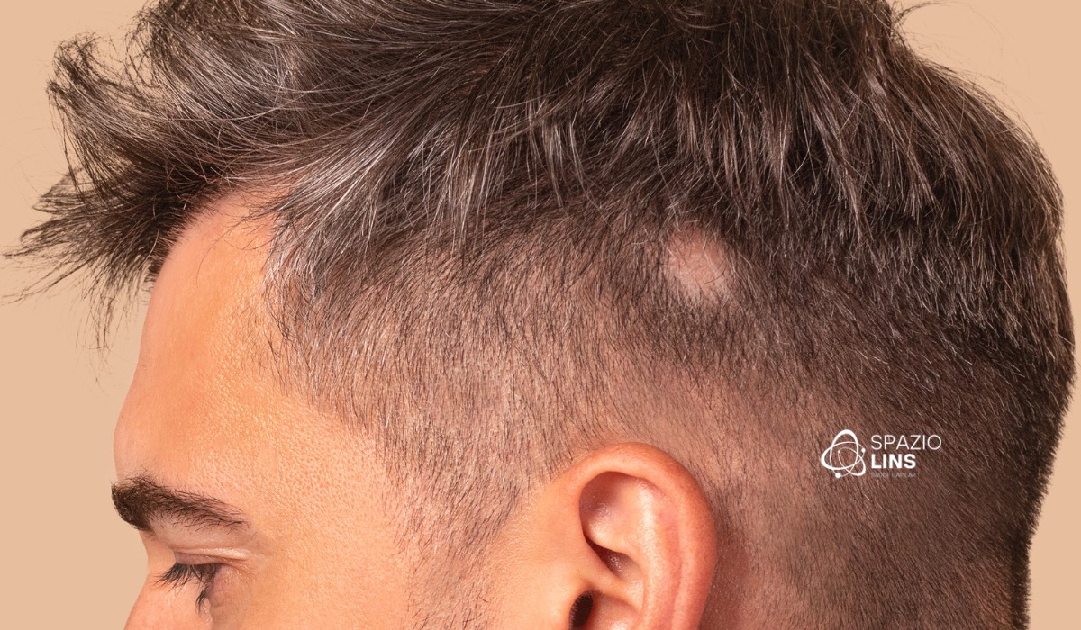 O que é alopecia? Entenda as causas, sintomas e tratamentos