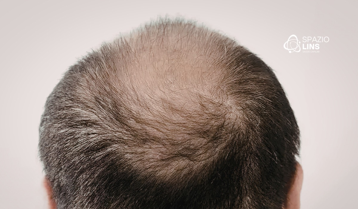 Como desacelerar a evolução da alopecia androgenética