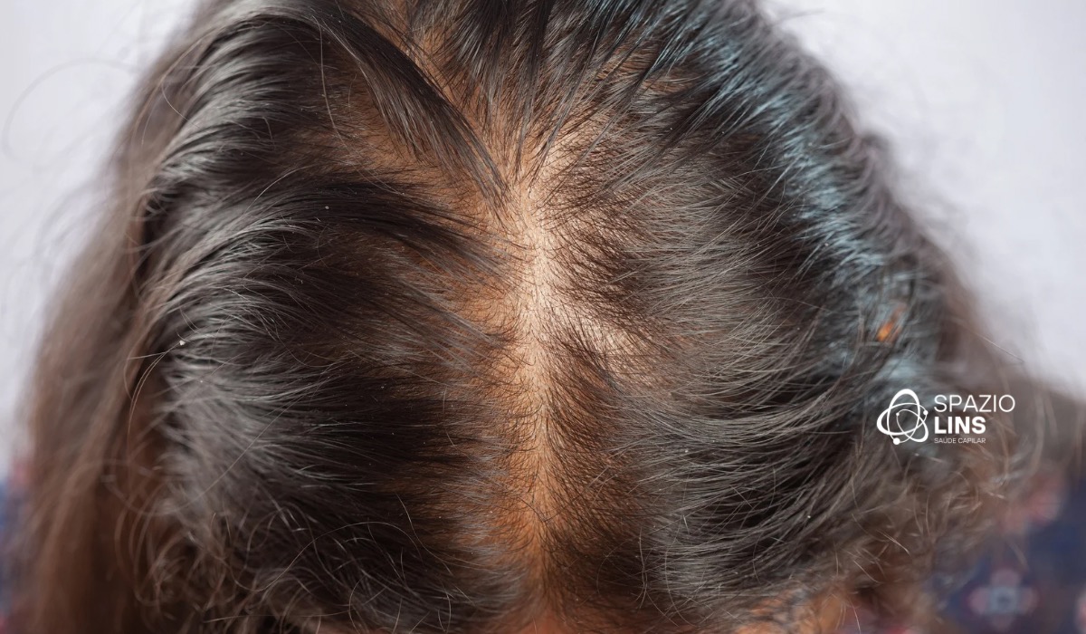 Como desacelerar a evolução da alopecia androgenética