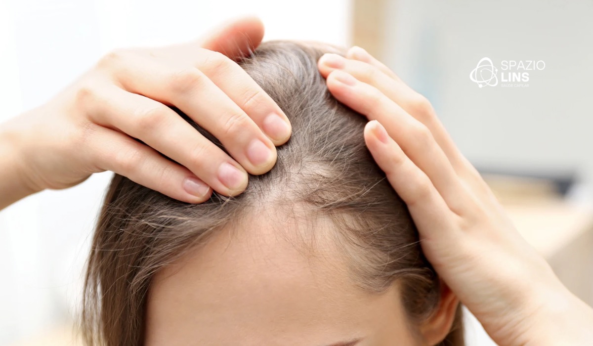 Por que mulheres estão desenvolvendo alopecia cada vez mais cedo?