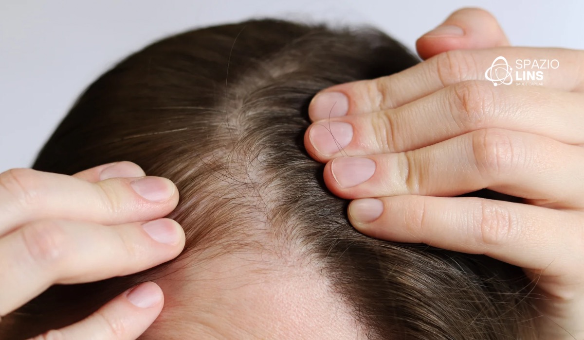 Por que mulheres estão desenvolvendo alopecia cada vez mais cedo?