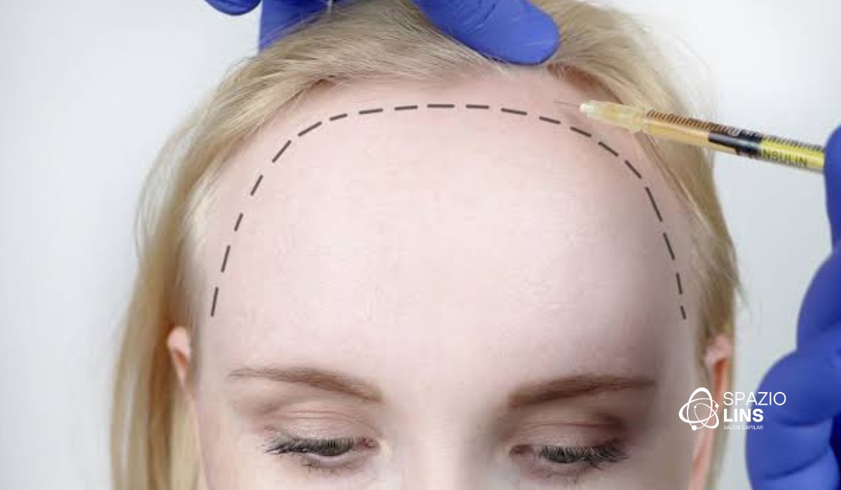 Alopecia frontal fibrosante: tudo o que você precisa saber