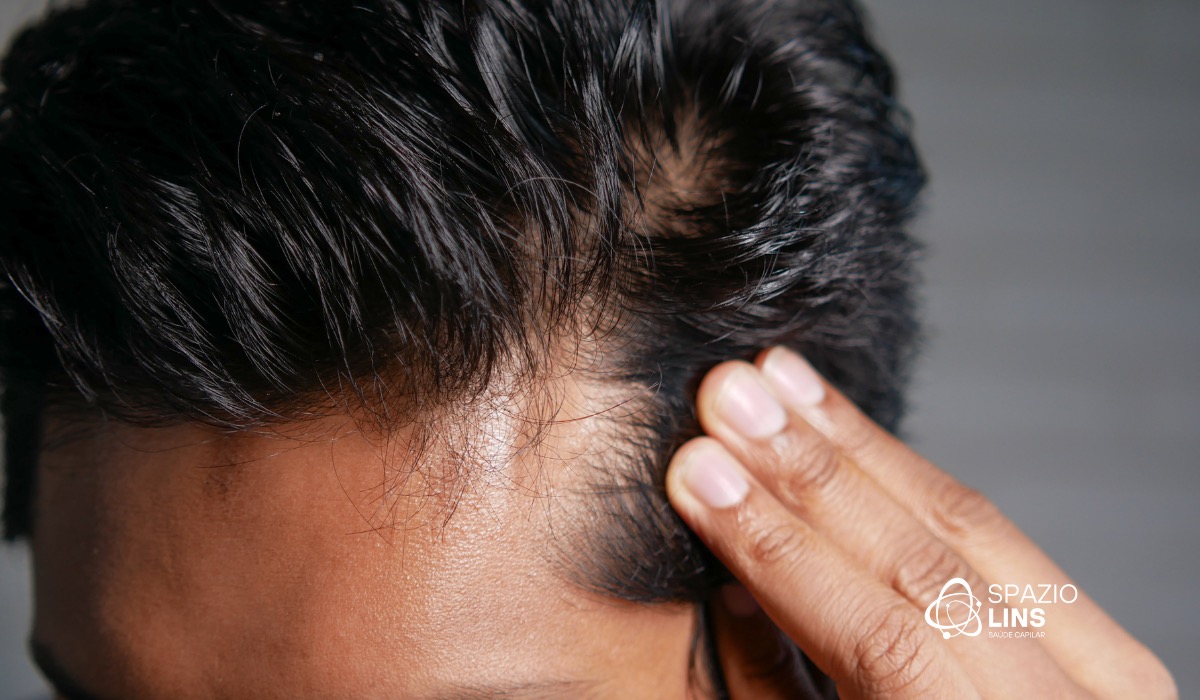 Queda de cabelo sazonal: isso existe?