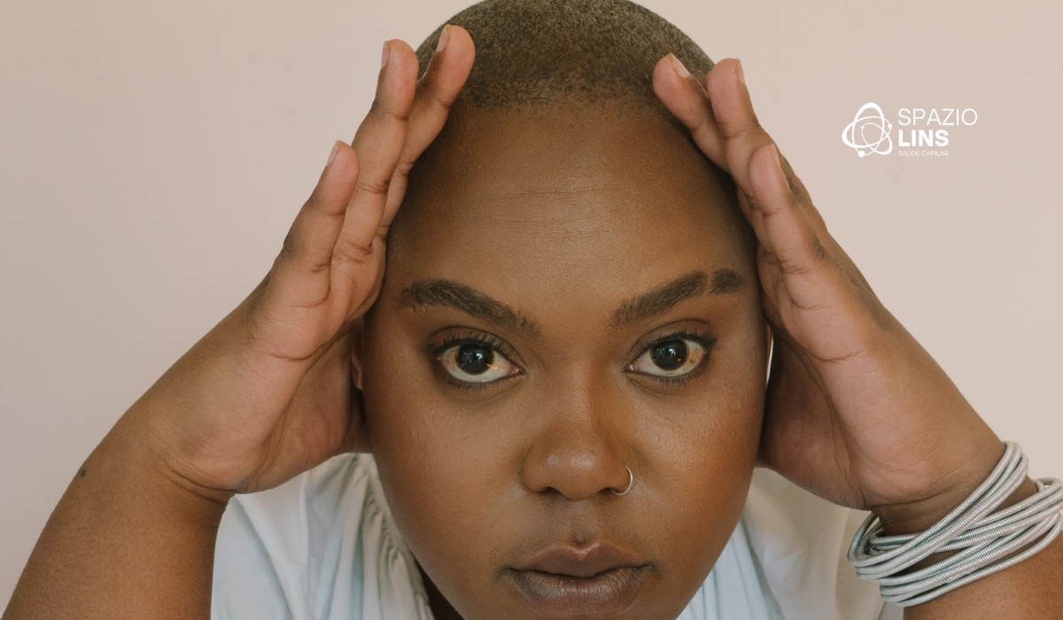 Alopecia frontal fibrosante: tudo o que você precisa saber