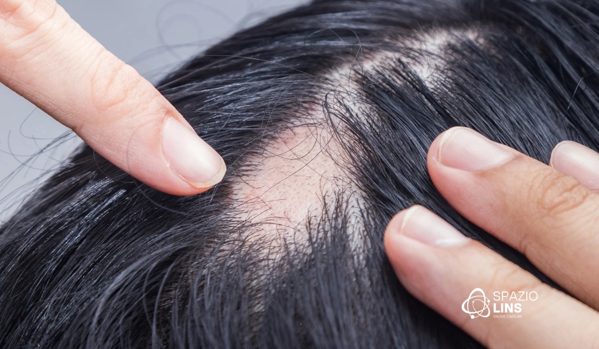O que é alopecia? Conheça os principais tipos