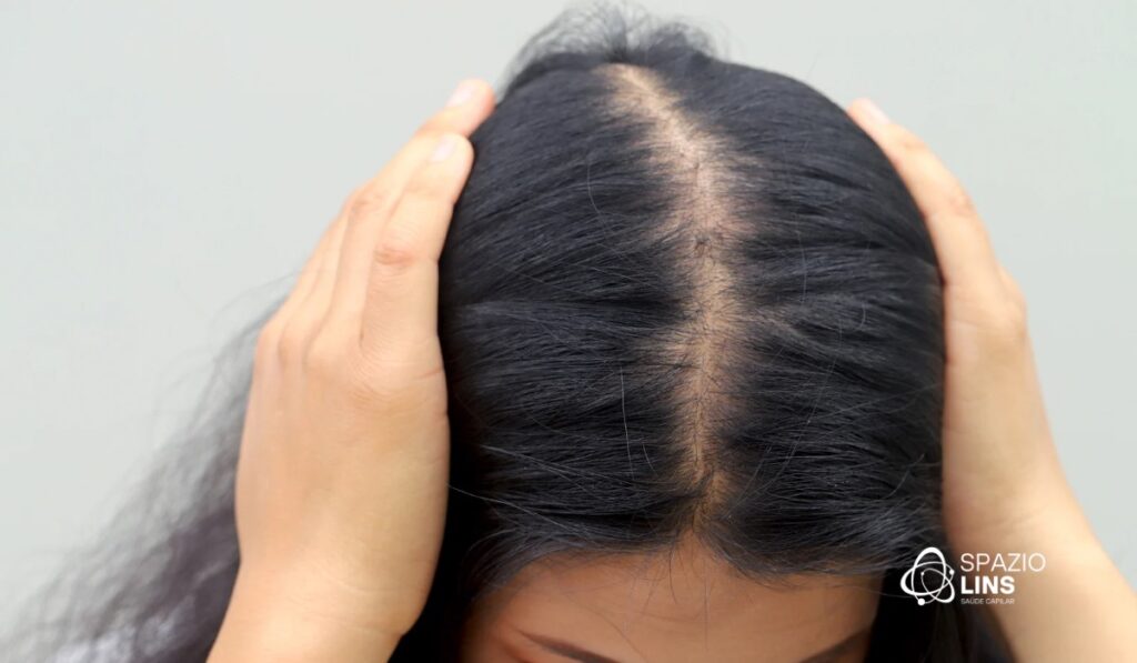Cabelo caindo pela raiz: o que significa?