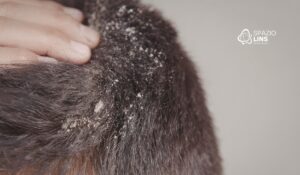 Dermatite seborreica pode destruir os folículos?