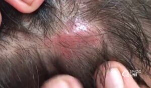 Foliculite no couro cabeludo: sintomas e tratamento