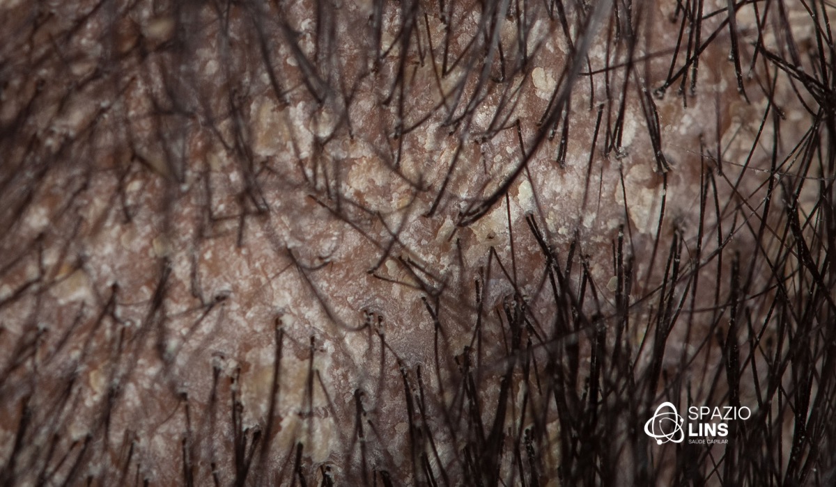 Dermatite seborreica pode destruir os folículos?