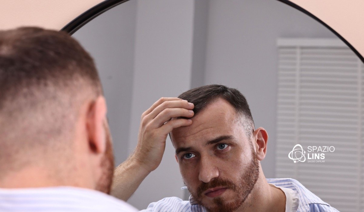 Calvície masculina: por que alguns homens perdem cabelo mais rapidamente que outros?