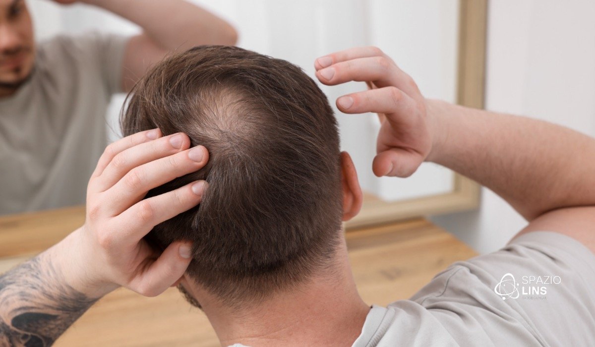 Por que a região da coroa é tão afetada pela calvície masculina?