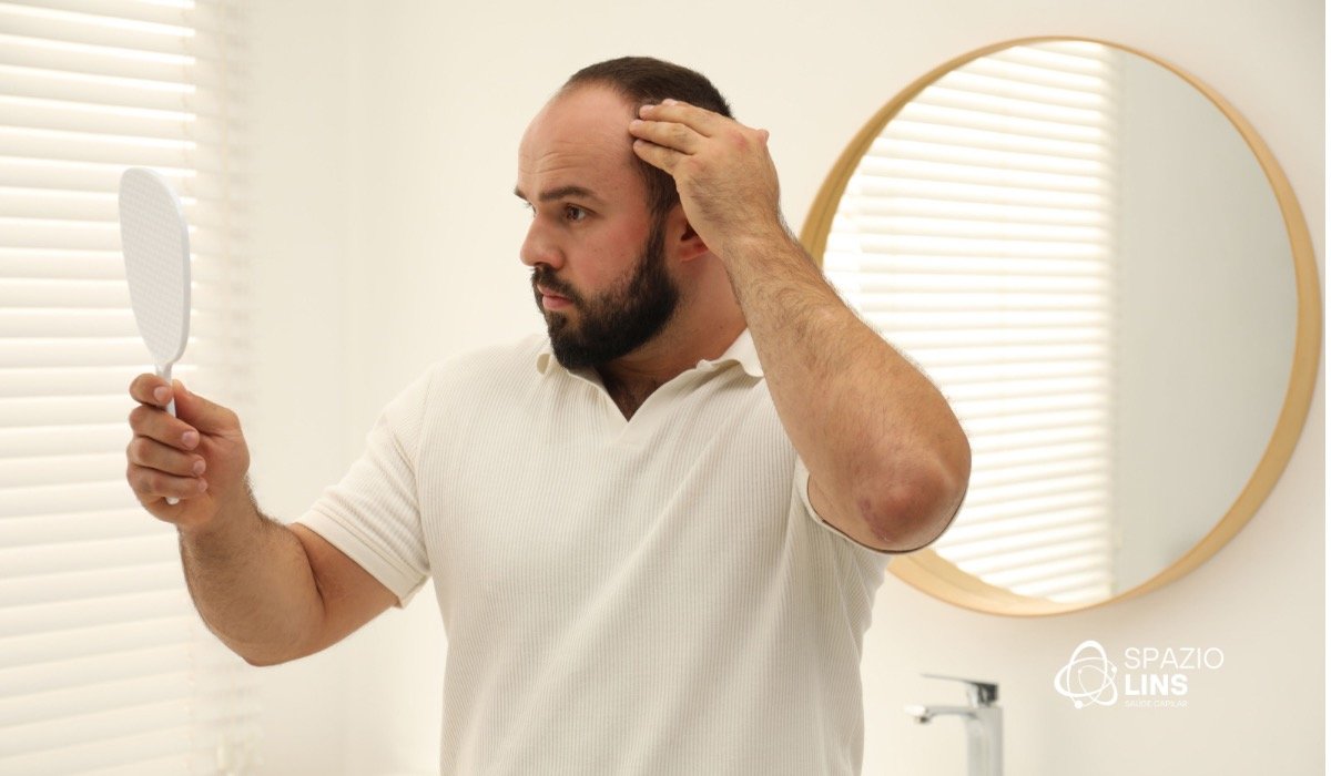 Entradas no cabelo: quando são naturais e quando podem indicar calvície?