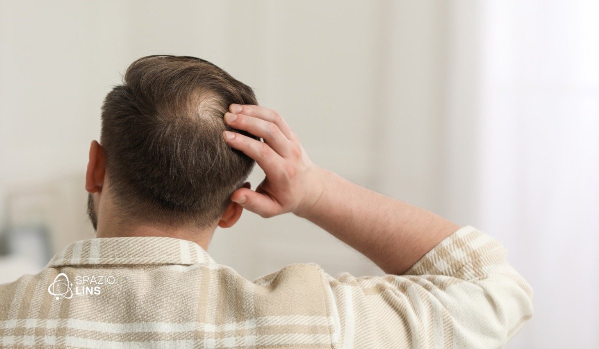 Por que a região da coroa é tão afetada pela calvície masculina?