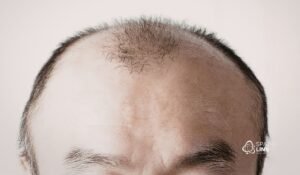 Alopecia androgenética tem cura? Entenda como controlar a progressão