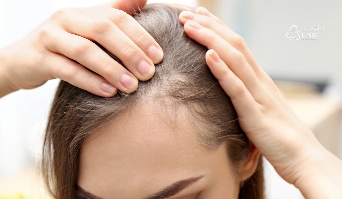 Alopecia feminina: o que é, principais tipos e como tratar