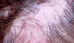 Alopecia cicatricial: quando a queda de cabelo pode ser definitiva