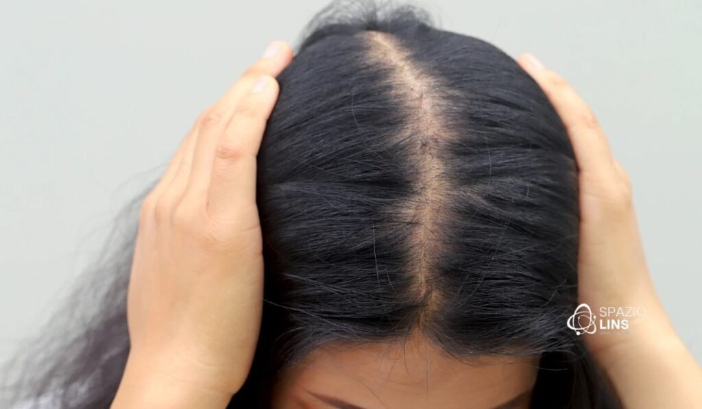 Alopecia feminina: o que é, principais tipos e como tratar