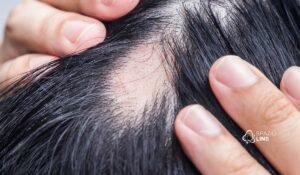 Alopecia areata: por que surgem falhas redondas no couro cabeludo?