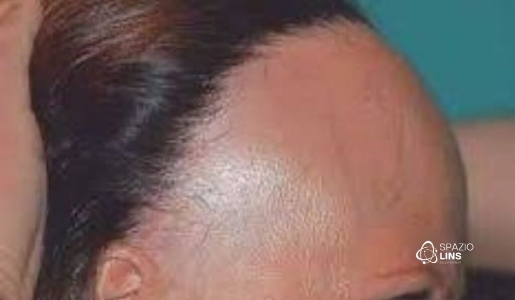 Alopecia frontal fibrosante: primeiros sinais que não devem ser ignorados