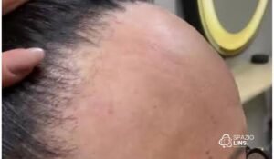 Alopecia frontal fibrosante: primeiros sinais que não devem ser ignorados